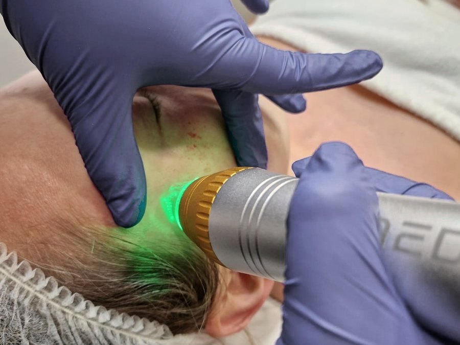 RFrax Lift, frakcyjna radiofrekwencja mikroigłowa Medika Poland w Laser Clinic Radom